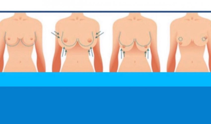 Mamoplastia De Aumento Vs Pexia Mamaria